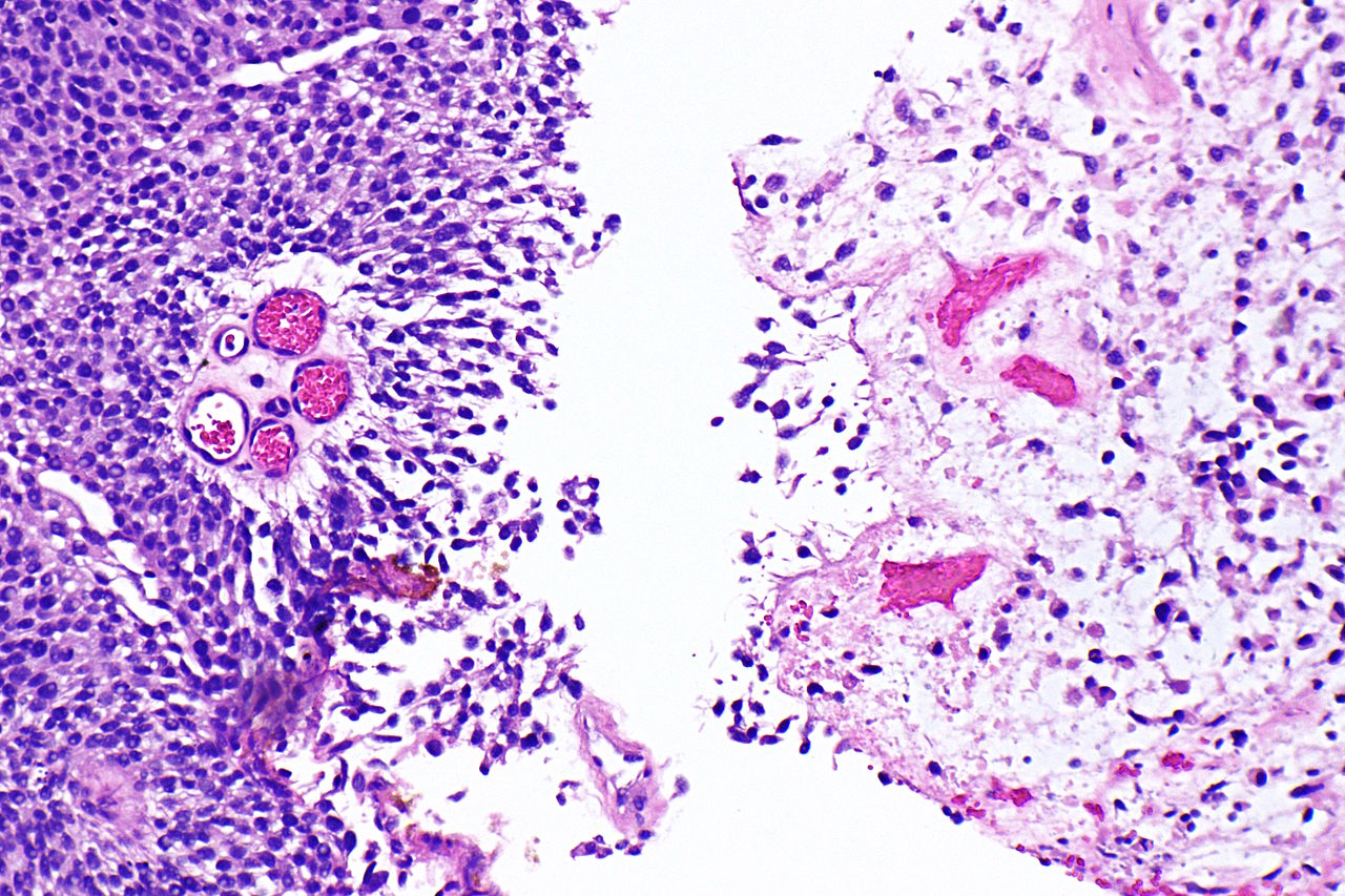 Micrograph of plasmacytoid urothelial carcinoma also plasmac