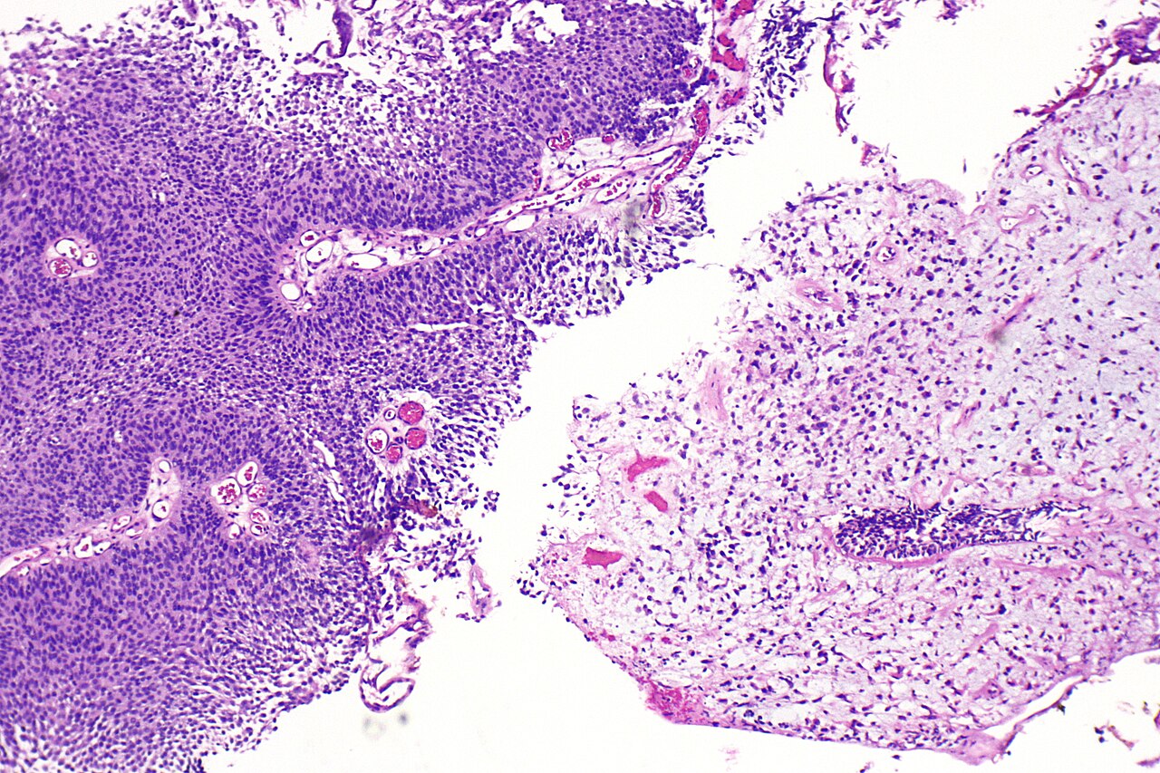 Micrograph of plasmacytoid urothelial carcinoma also plasmac