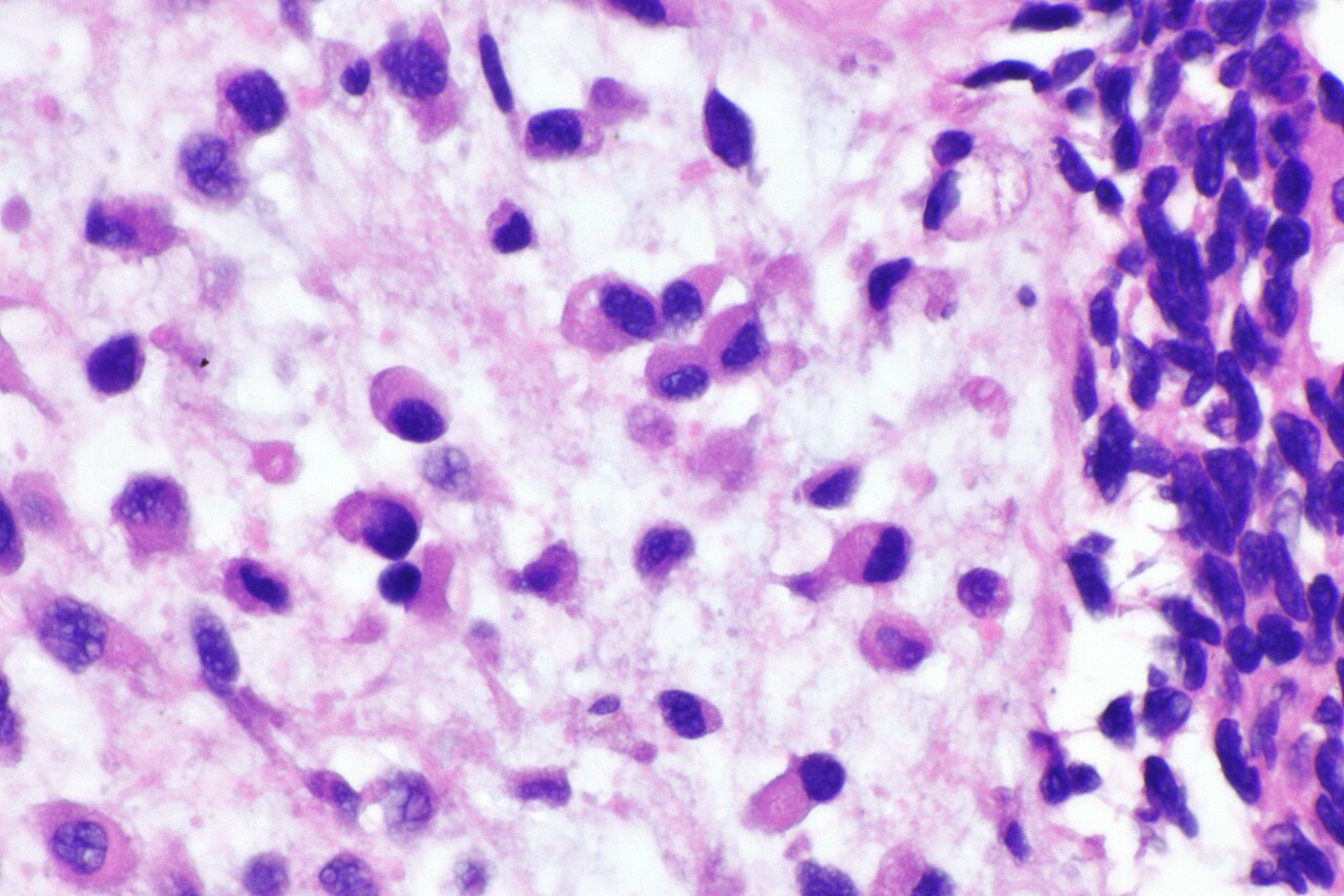 Micrograph of plasmacytoid urothelial carcinoma also plasmac