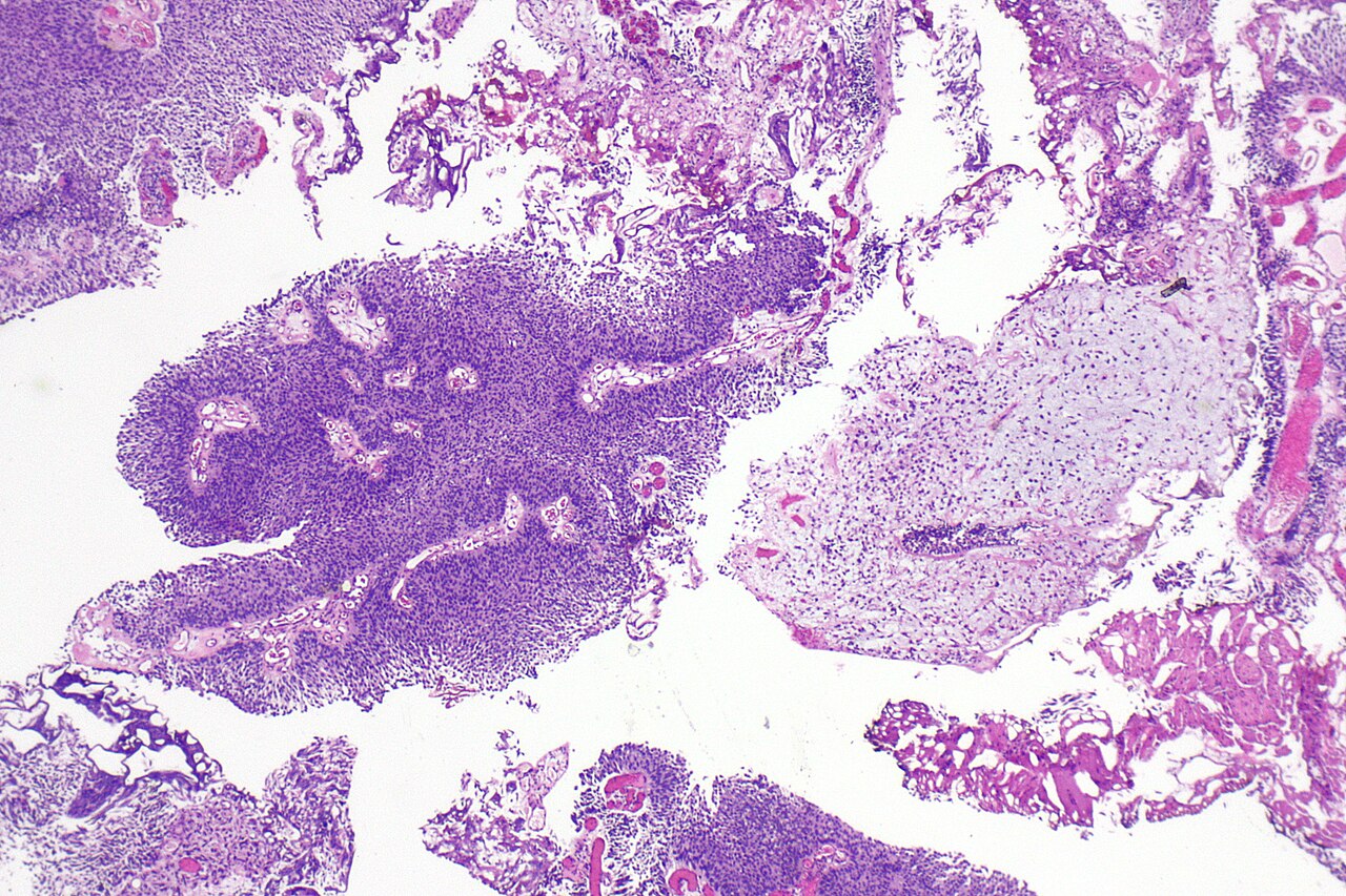 Micrograph of plasmacytoid urothelial carcinoma also plasmac