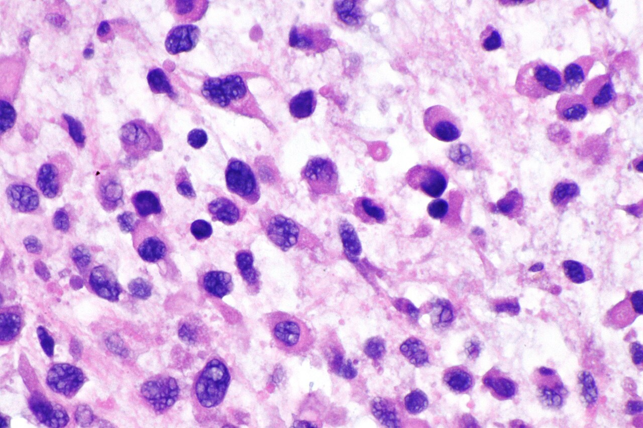 Micrograph of plasmacytoid urothelial carcinoma also plasmac