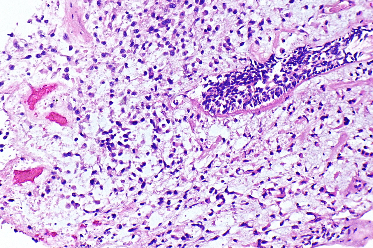 Micrograph of plasmacytoid urothelial carcinoma also plasmac