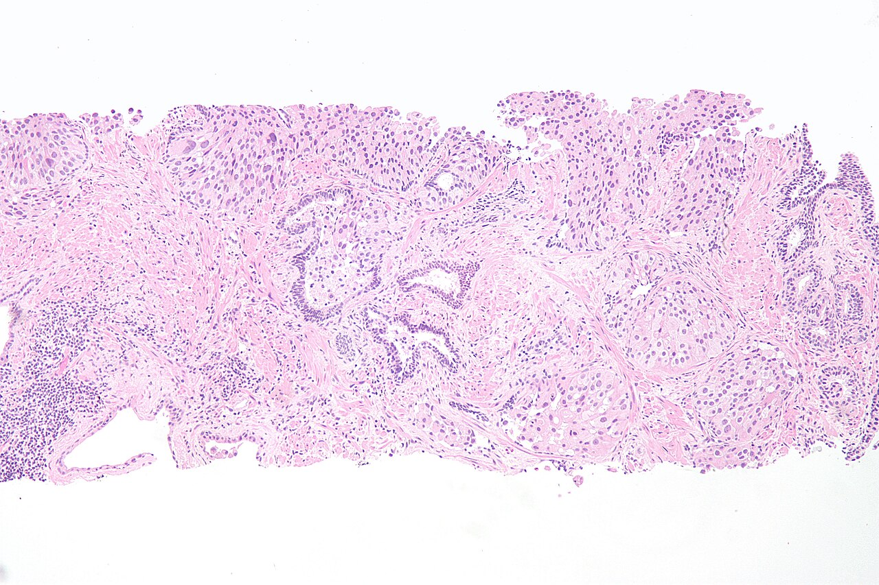 Micrograph of urothelial cell carcinoma of the prostatic ure