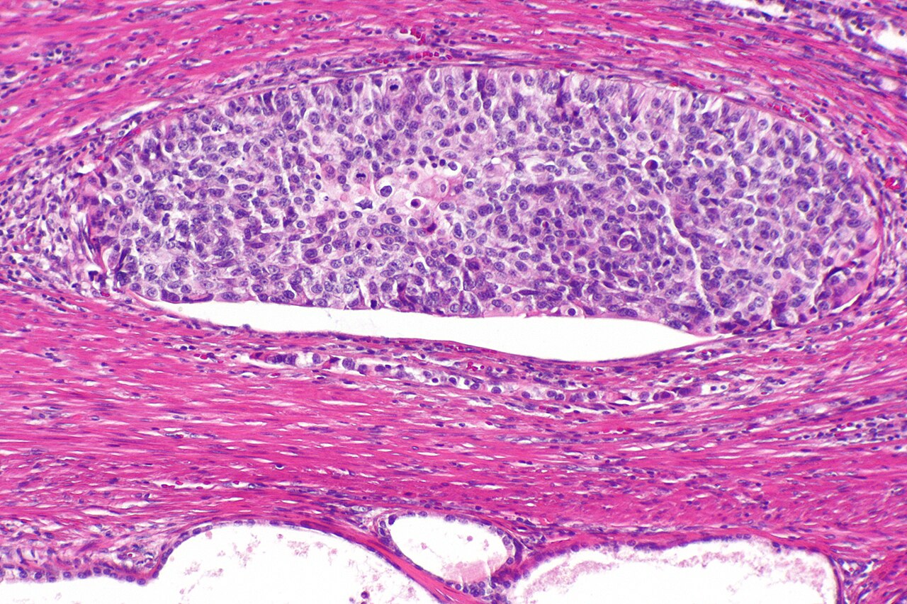 Micrograph of urothelial carcinoma also urothelial cell carc