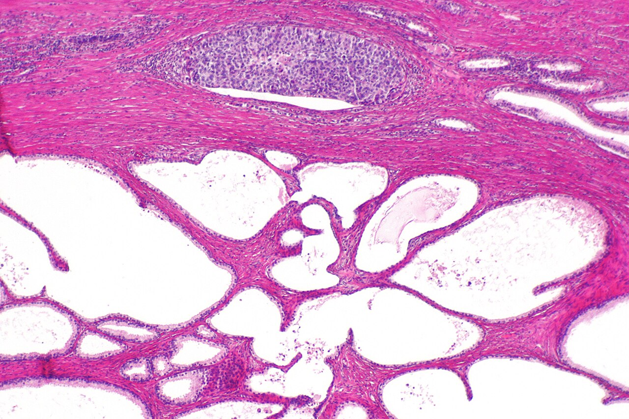 Micrograph of urothelial carcinoma also urothelial cell carc