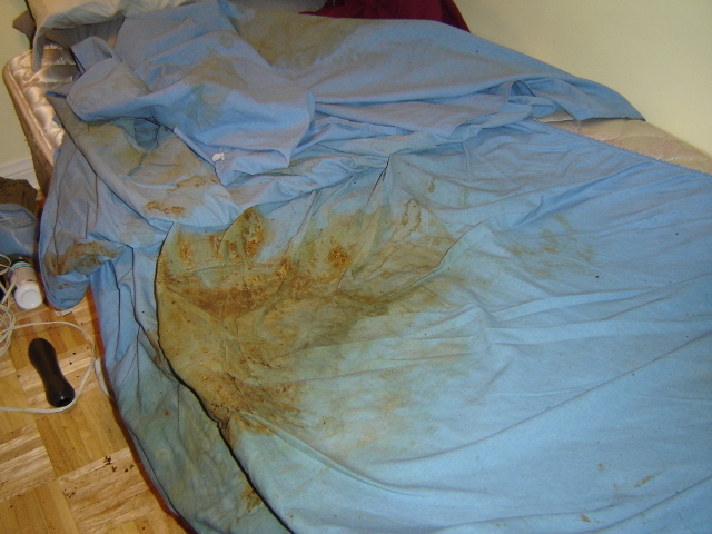 The result of fecal incontinence