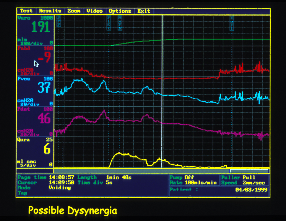 This is not a good picture as there is no emg tracing strict