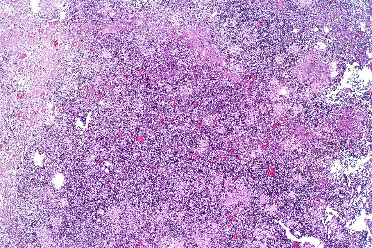 Bacillus calmette guerin bcg induced cystitis showing chroni