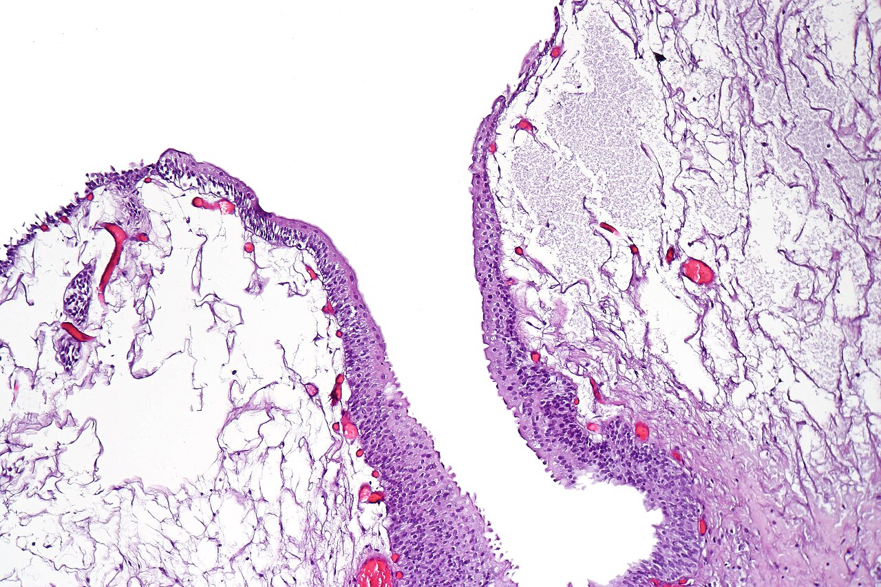 Bullous cystitis with prominent edematous broad based papill