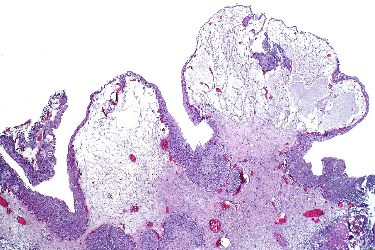 Bullous cystitis with prominent edematous broad based papill