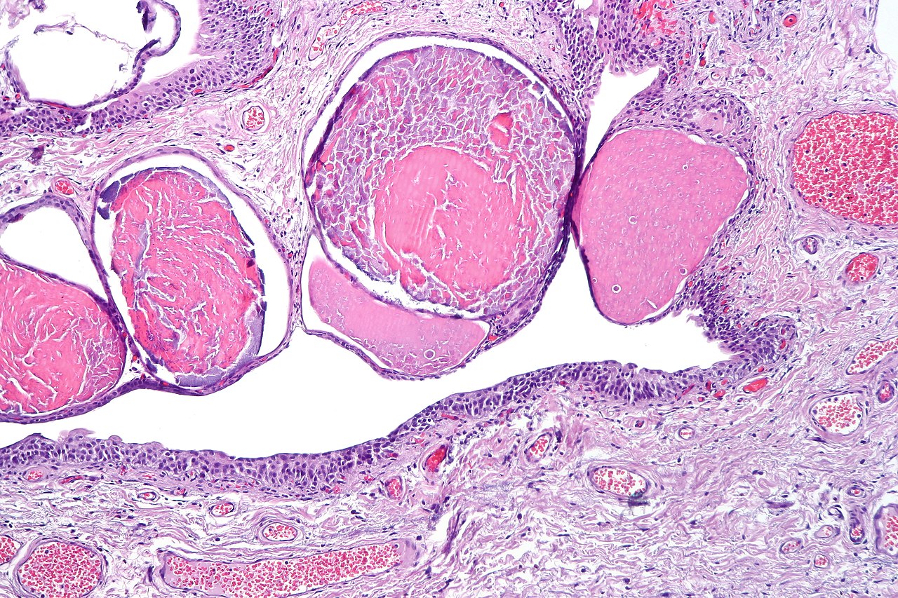 Cystitis cystica showing nests of urothelium with dilated lu