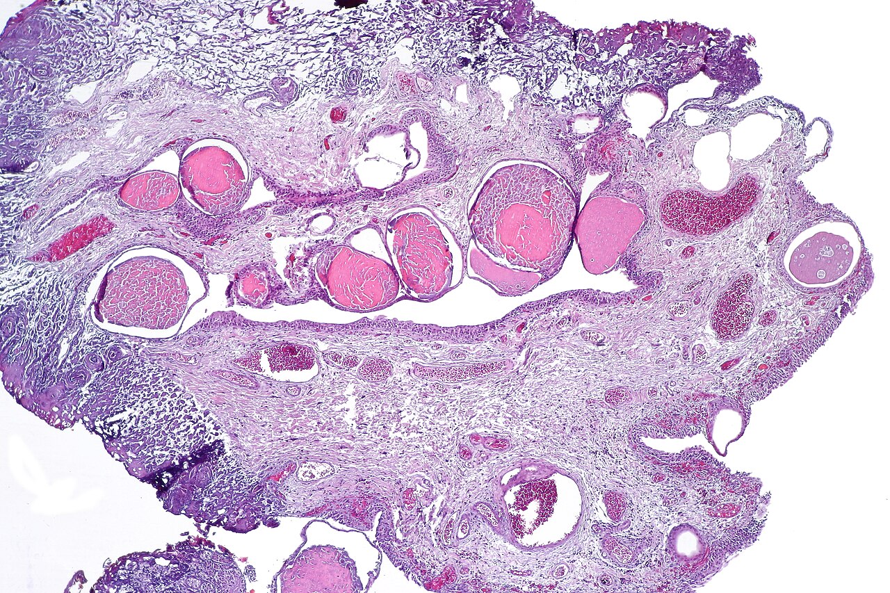 Cystitis cystica showing nests of urothelium with dilated lu