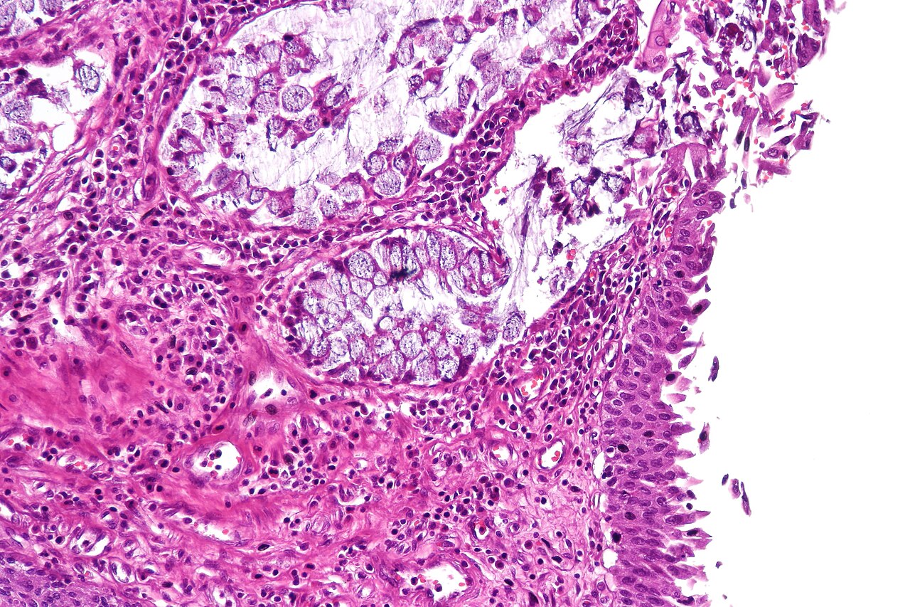 Cystitis glandularis intestinal type showing mucin secreting