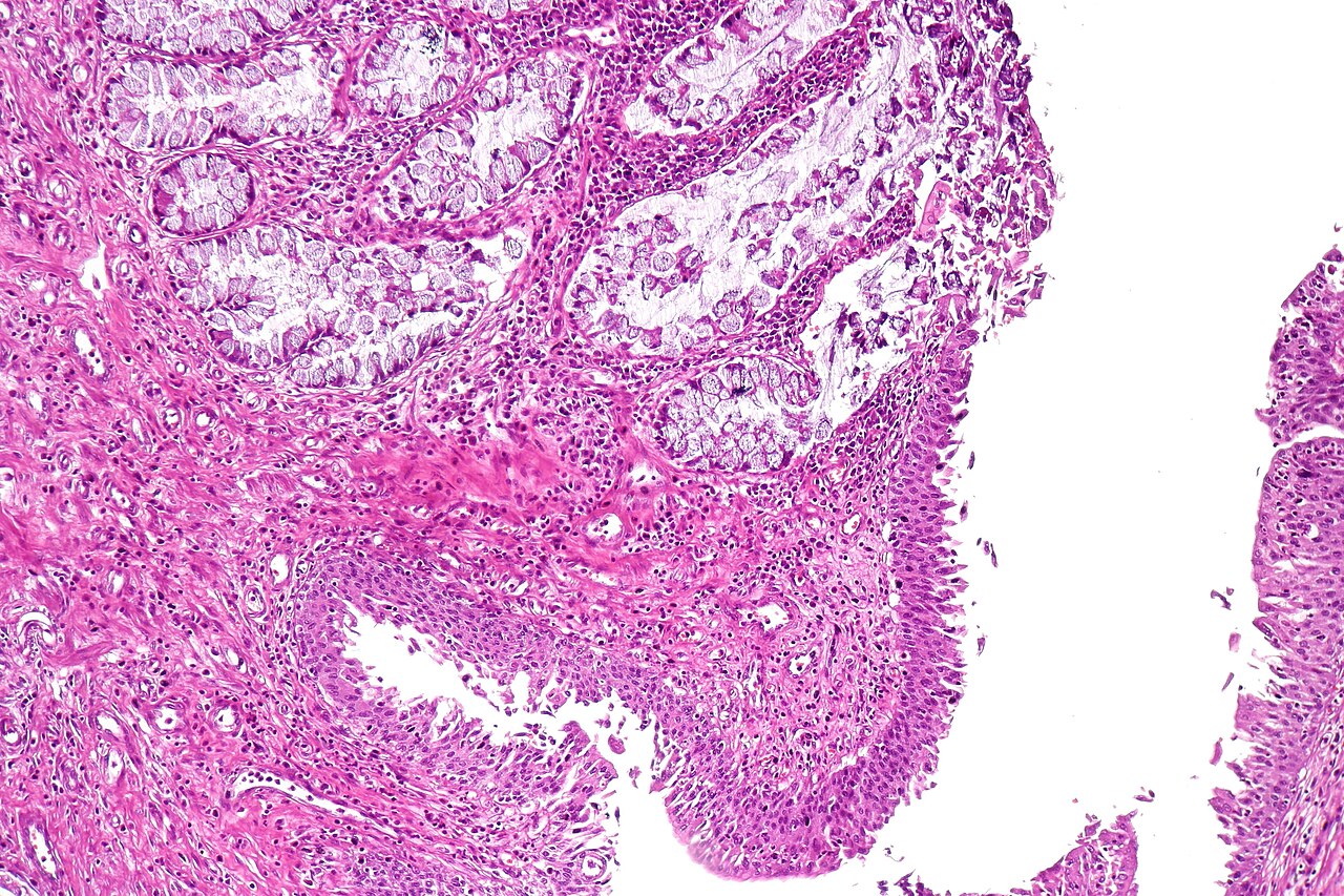 Cystitis glandularis intestinal type showing mucin secreting