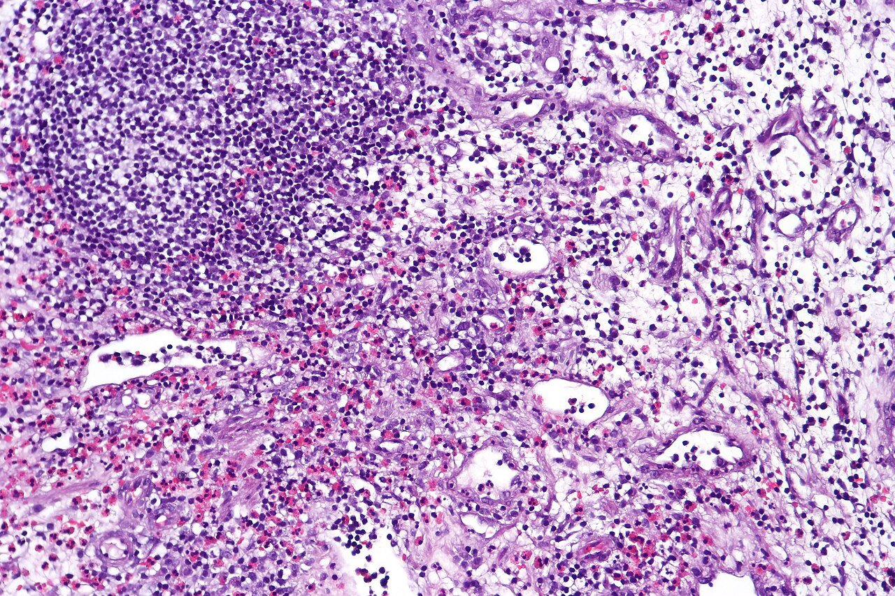 Eosinophilic cystitis showing edematous and chronically infl
