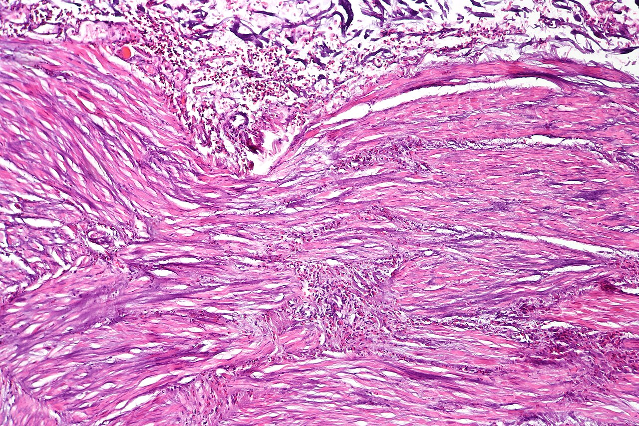 Eosinophilic cystitis showing prominent eosinophils in the m
