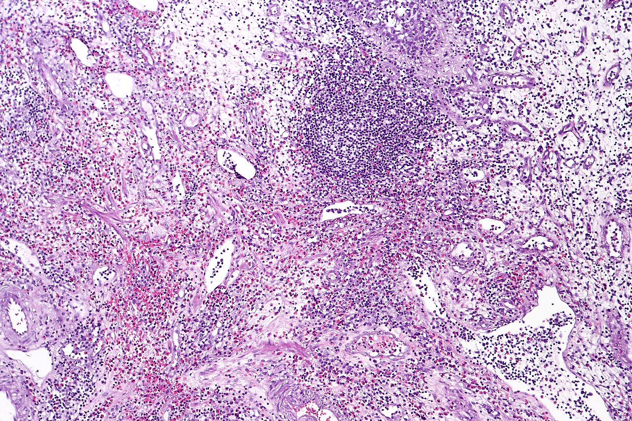Eosinophilic cystitis showing edematous and chronically infl