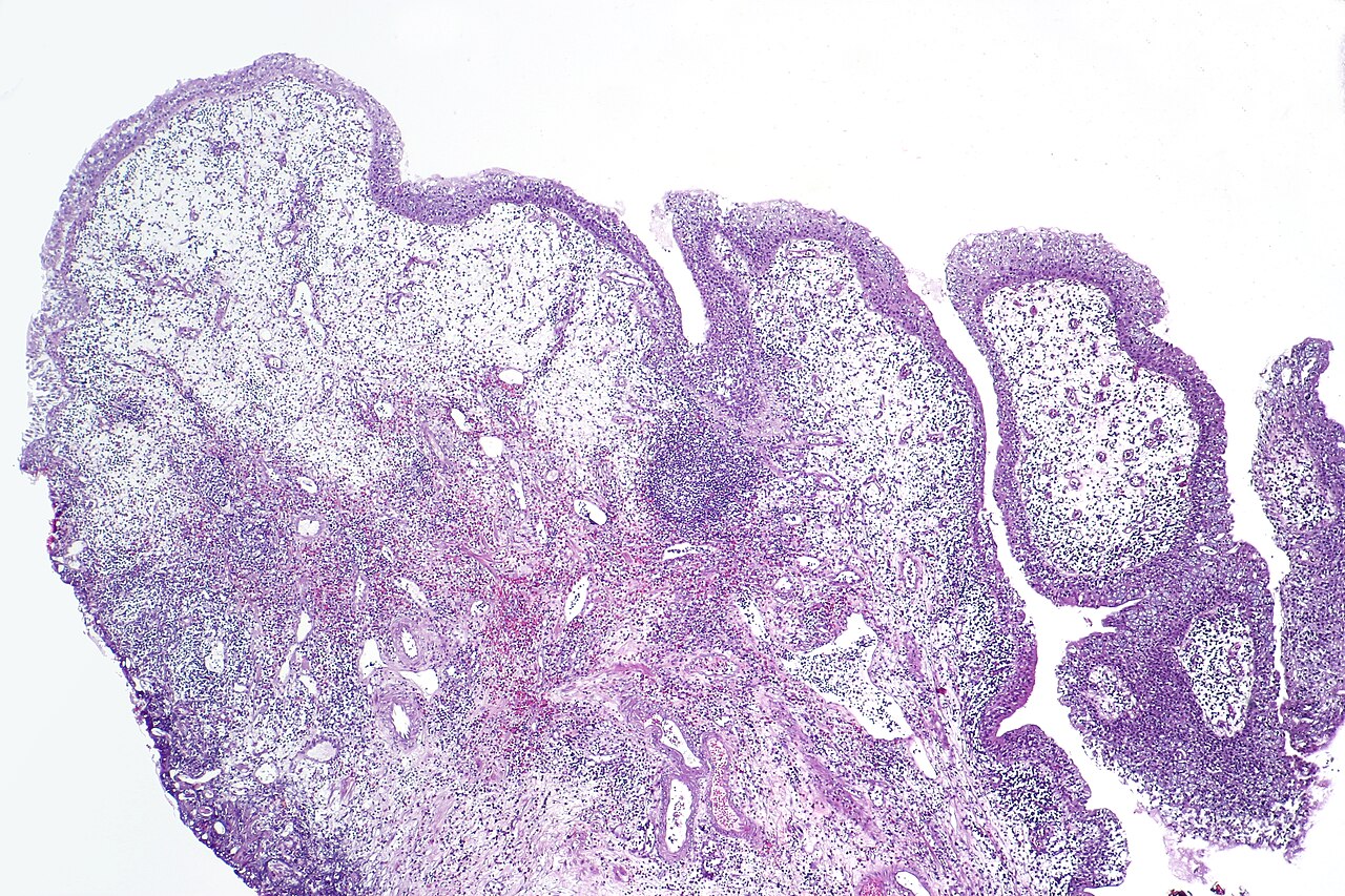Eosinophilic cystitis showing edematous and chronically infl