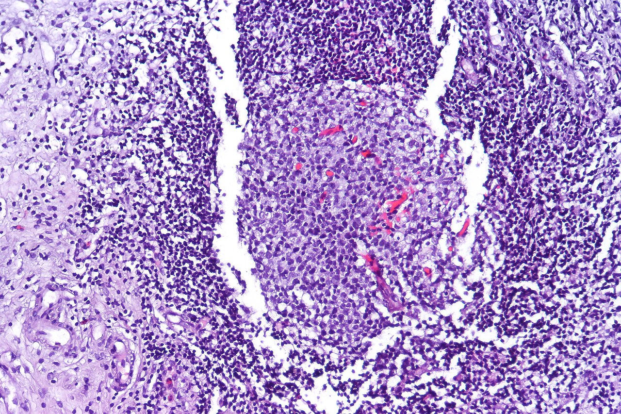 Follicular cystitis showing numerous lymphoid follicles in t