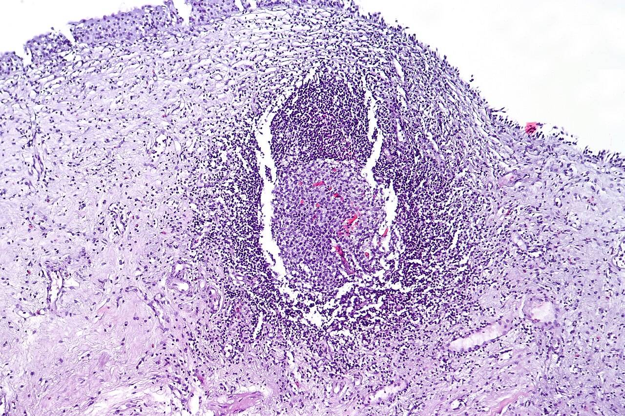 Follicular cystitis showing numerous lymphoid follicles in t