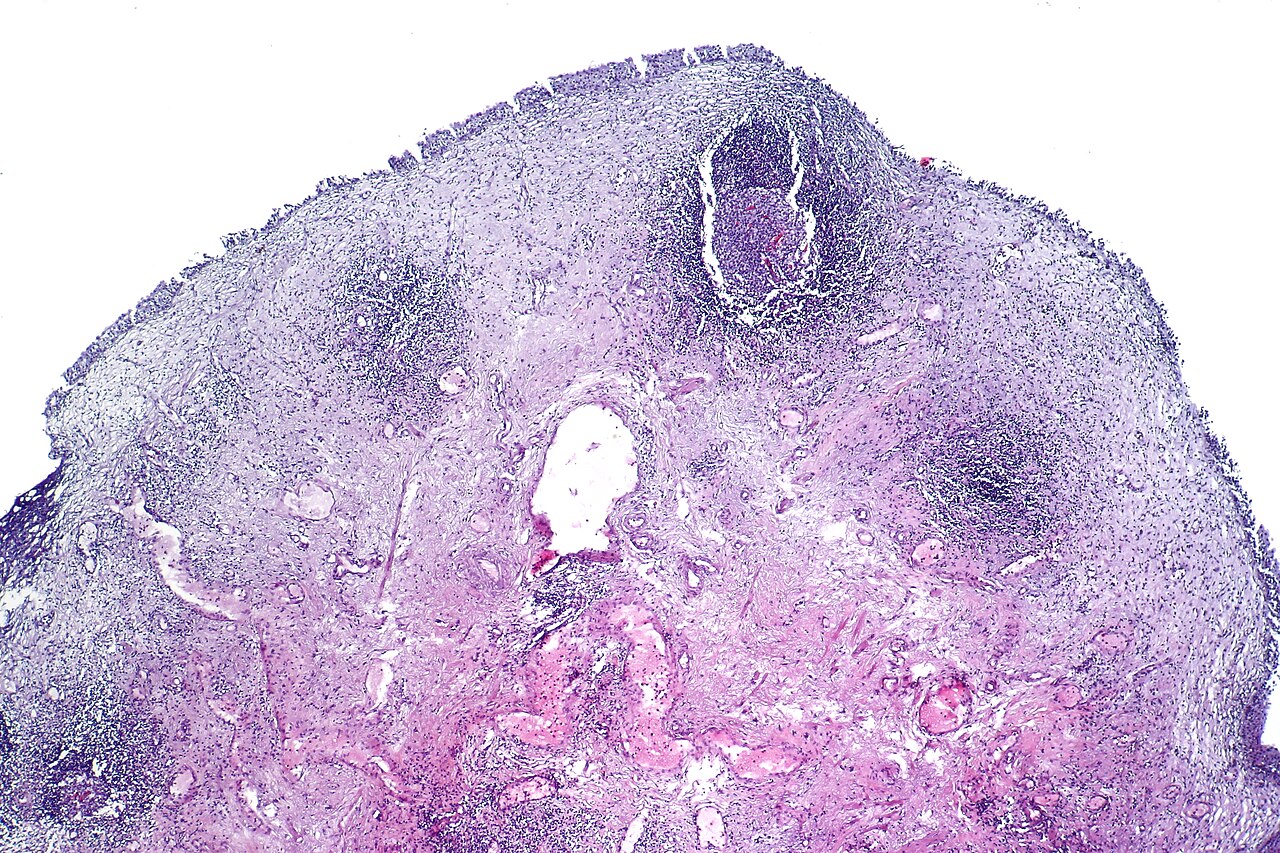 Follicular cystitis showing numerous lymphoid follicles in t