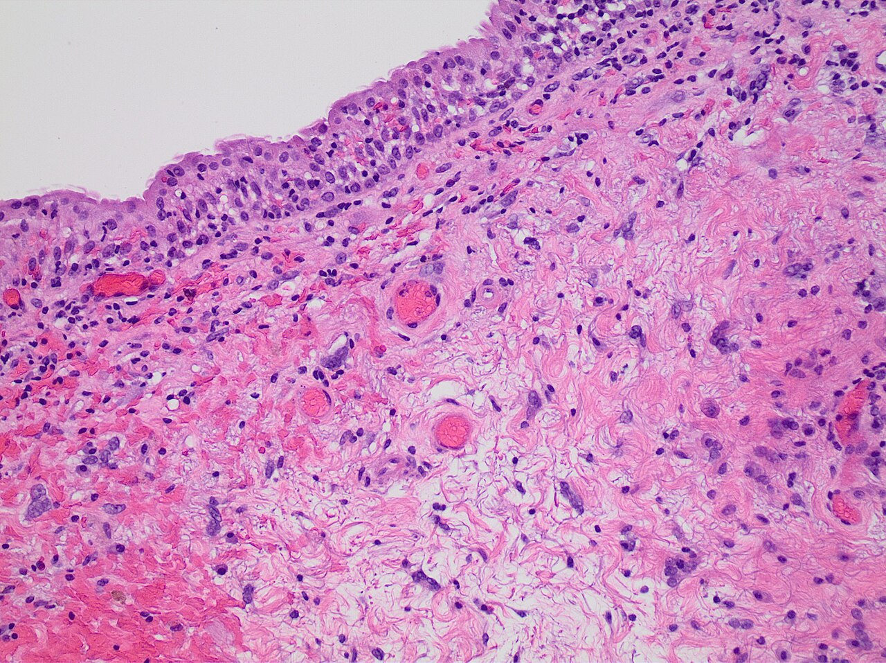 Histopathology of radiation cystitis with atypical stromal c