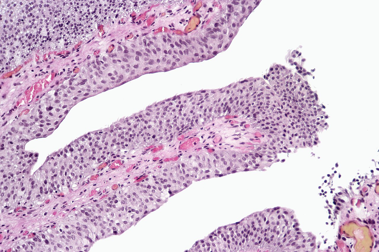 Papillary cystitis with finger like projections and ectatic