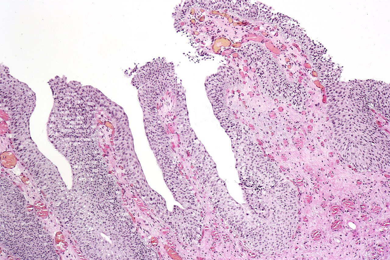 Papillary cystitis with finger like projections and ectatic