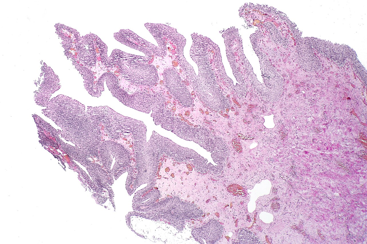Papillary cystitis with finger like projections and ectatic