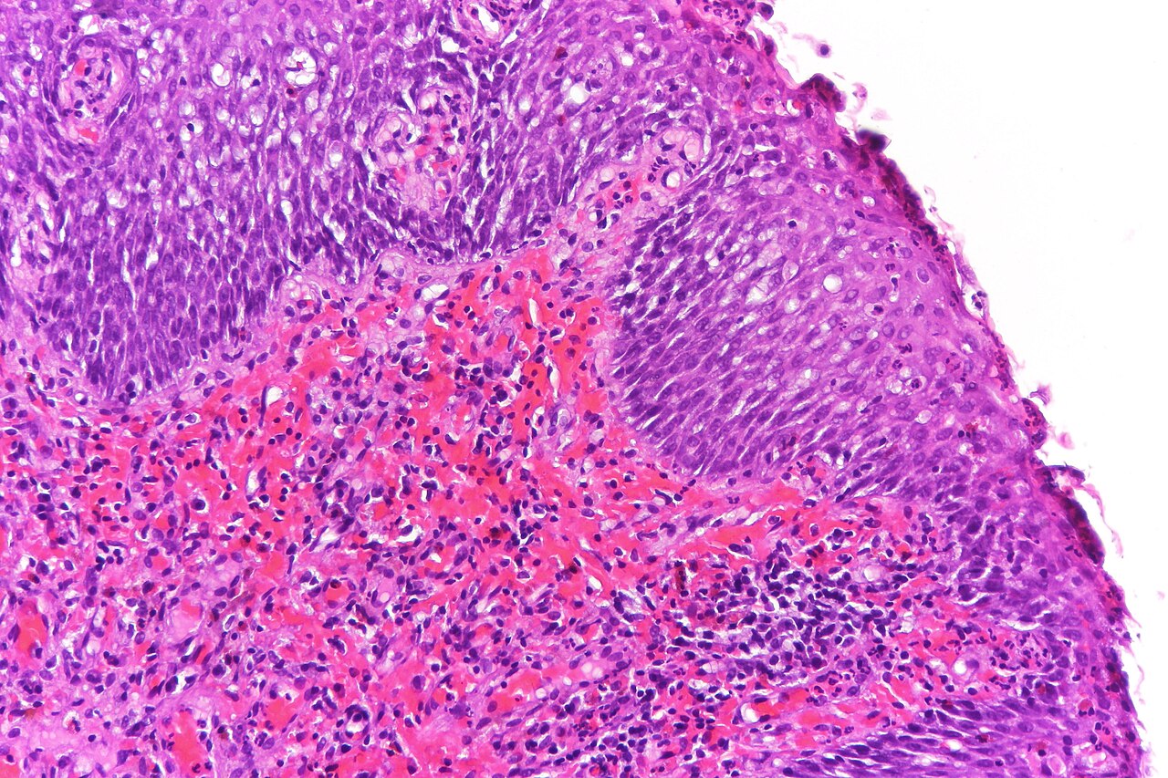 Polypoid cystitis showing broad polypoid growth prominent bl