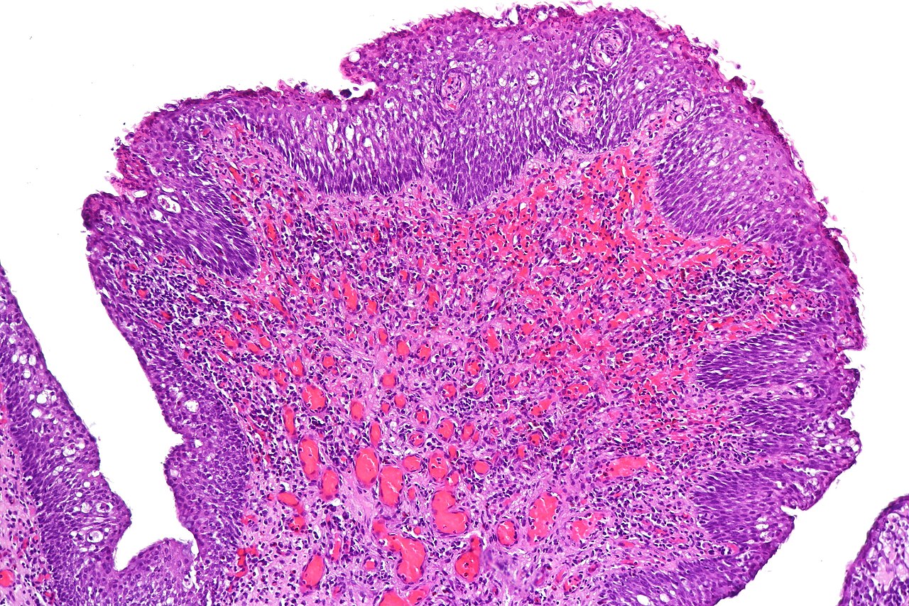 Polypoid cystitis showing broad polypoid growth prominent bl
