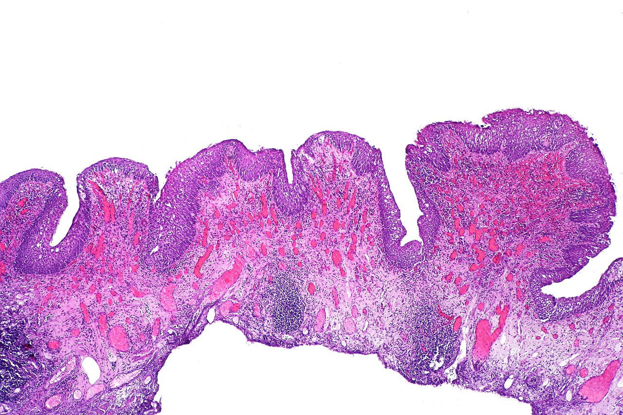 Polypoid cystitis showing broad polypoid growth prominent bl