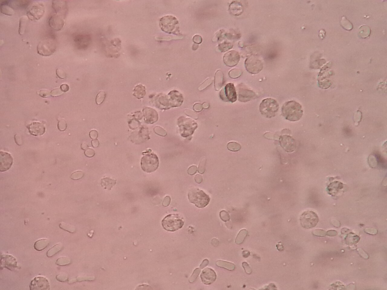 In a urine microscopy sample from a patient with a fungal ut