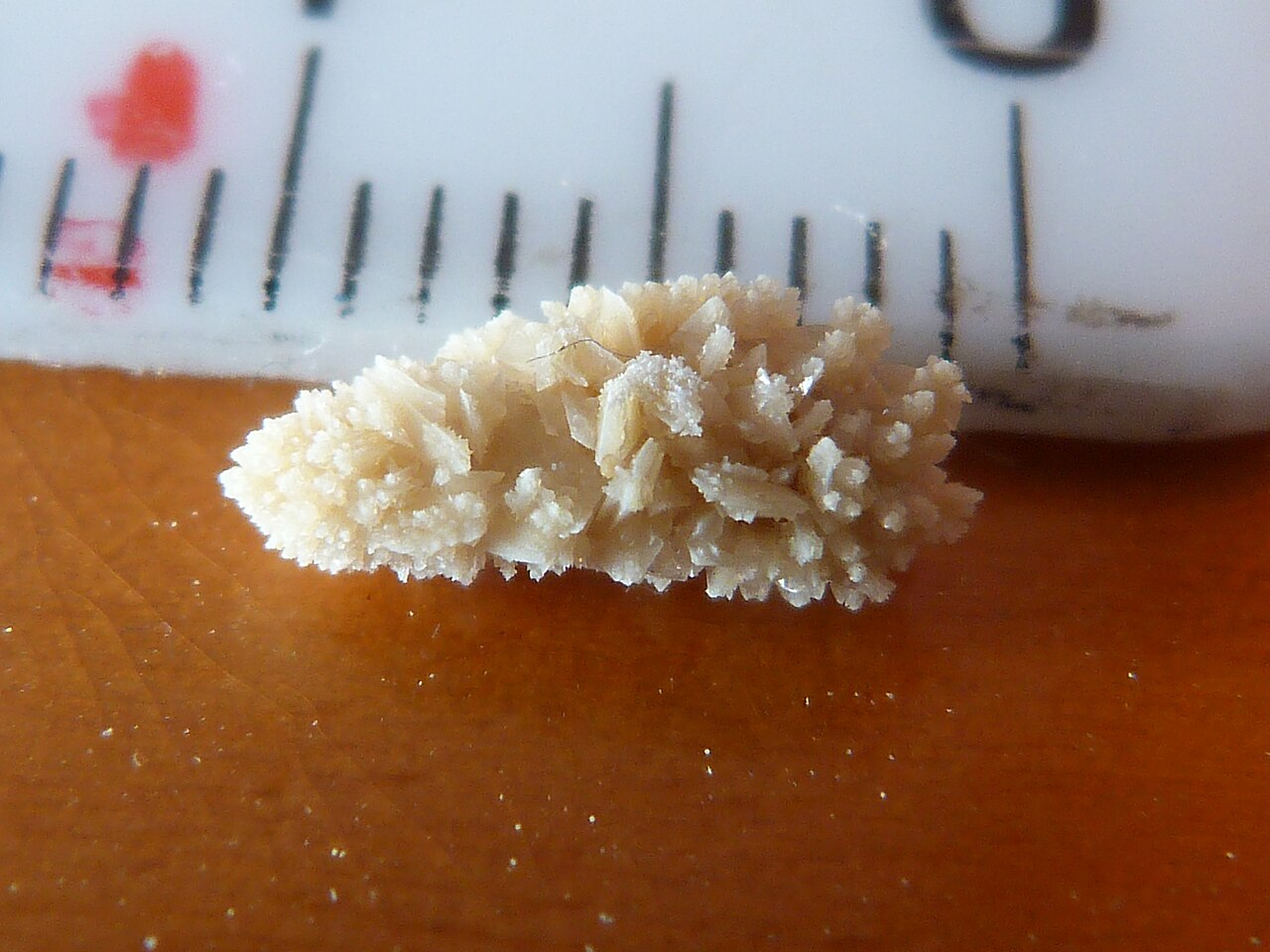 A kidney stone