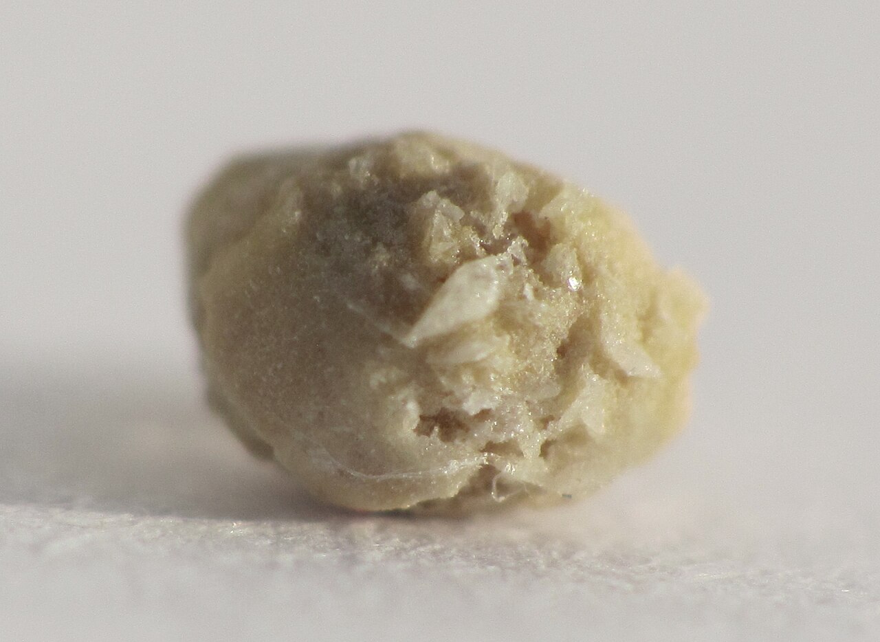 Kidney stone 4mm