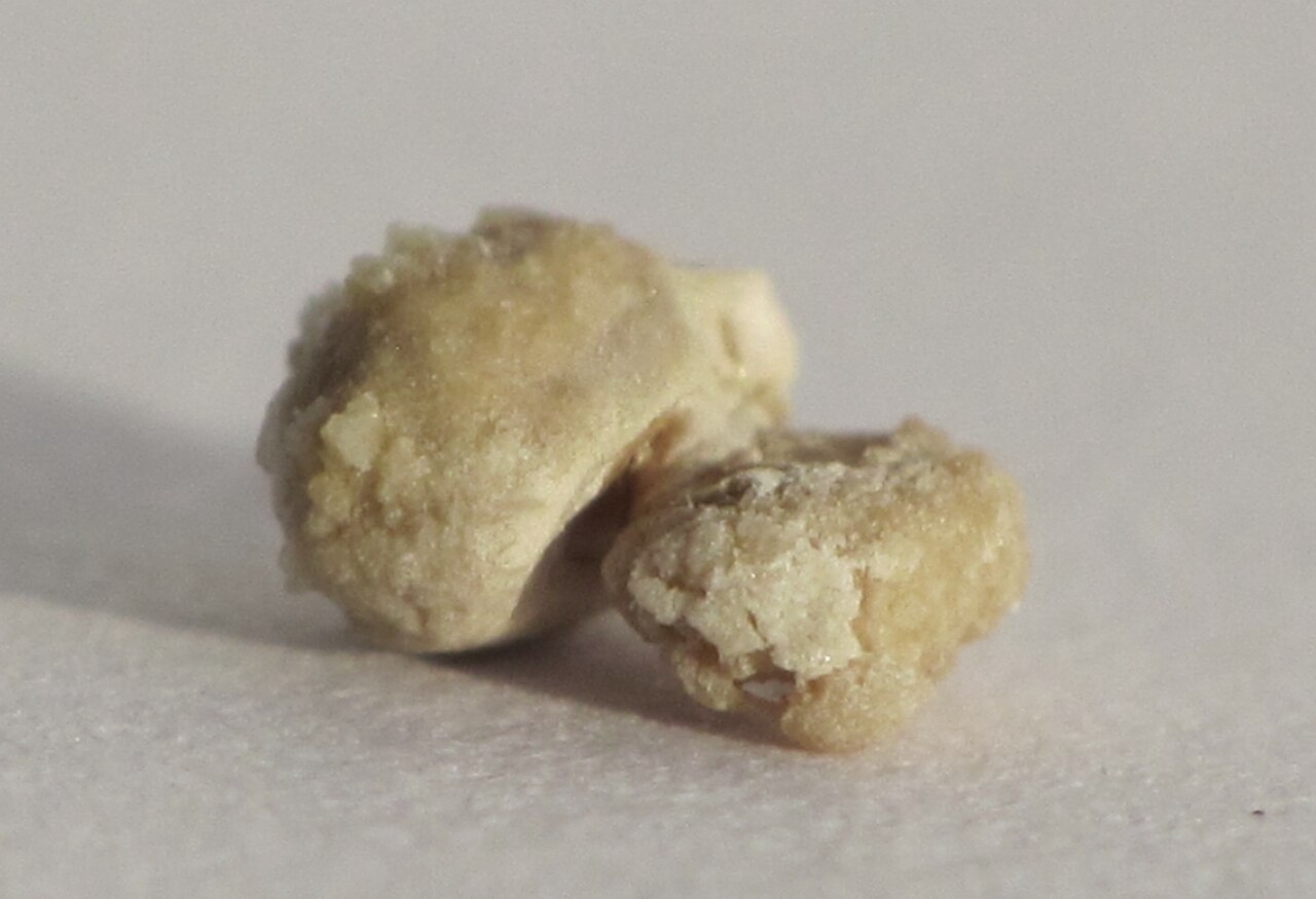 Kidney stone 4mm