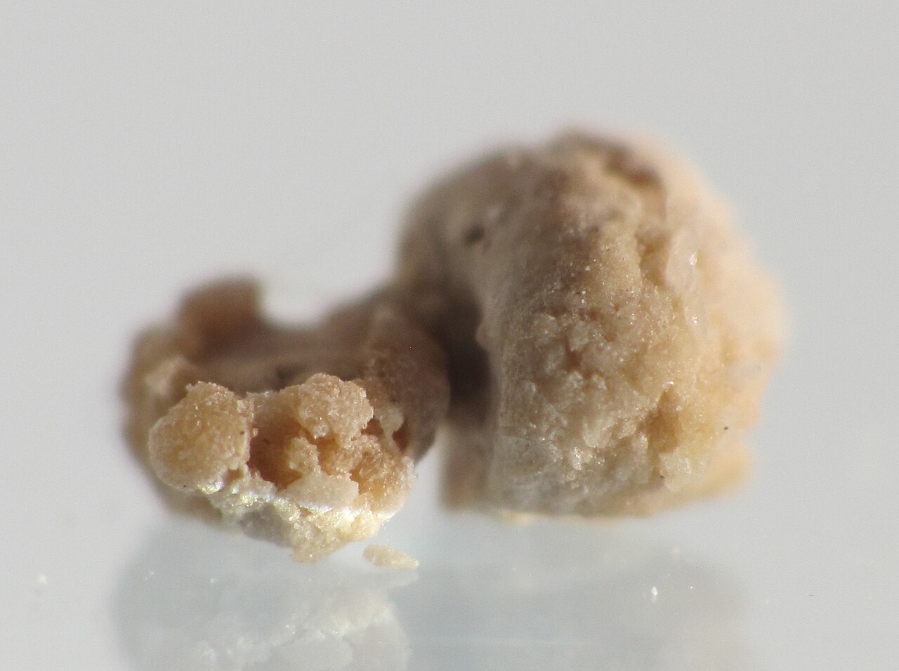 Kidney stone 4mm
