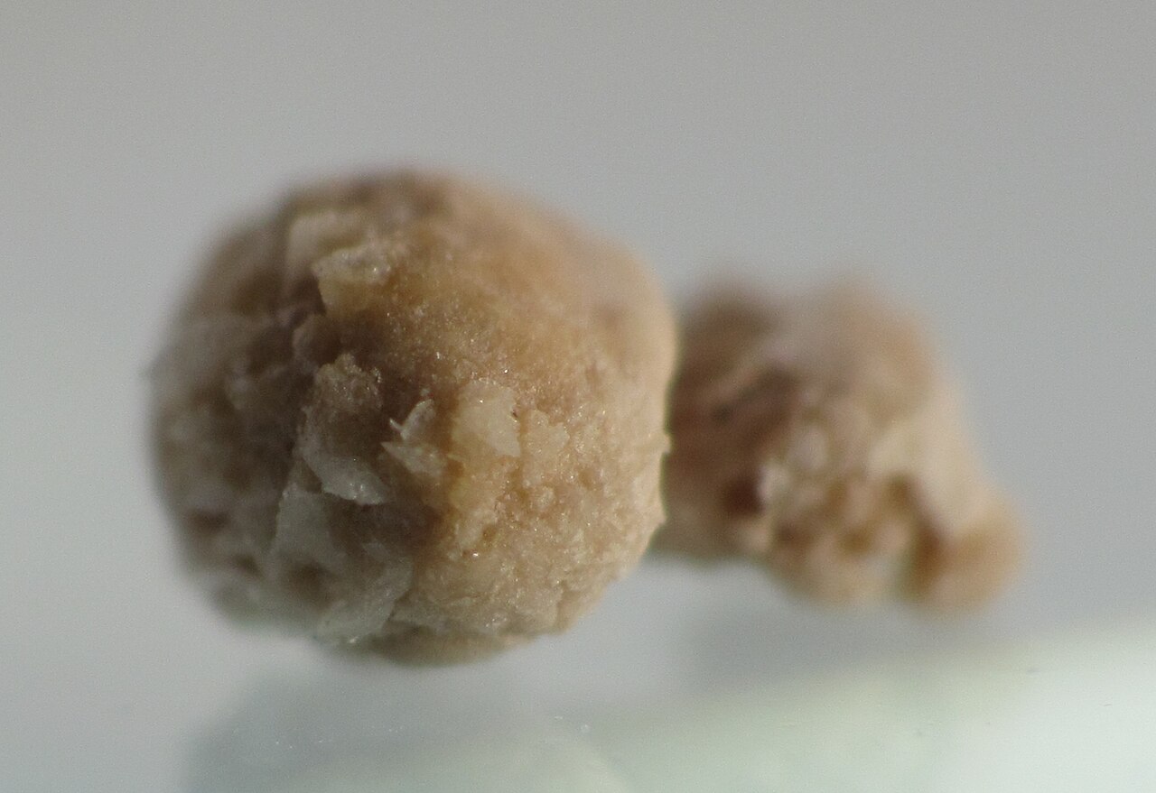 Kidney stone 4mm