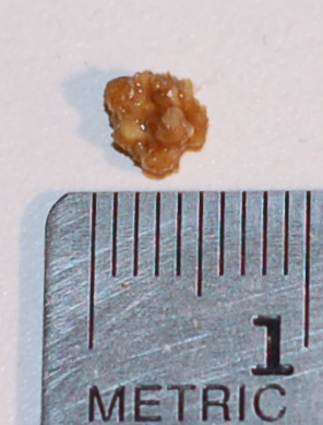 Kidney stone with a maximum dimension of 5mm