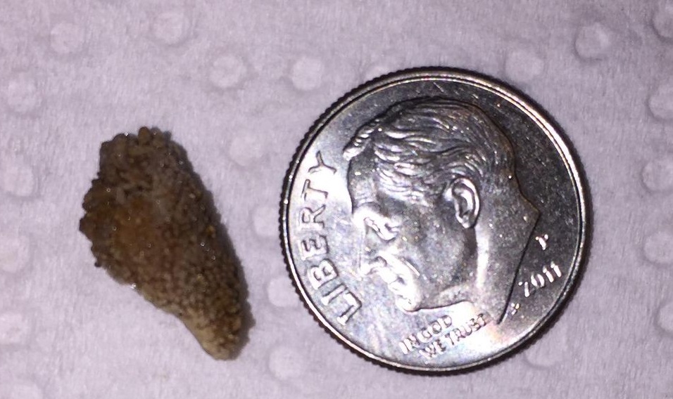 A dark kidney stone is excreted in a woman s urine in her 60
