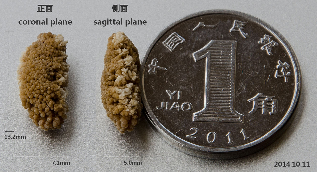 A lenticular kidney stone excreted by the urine