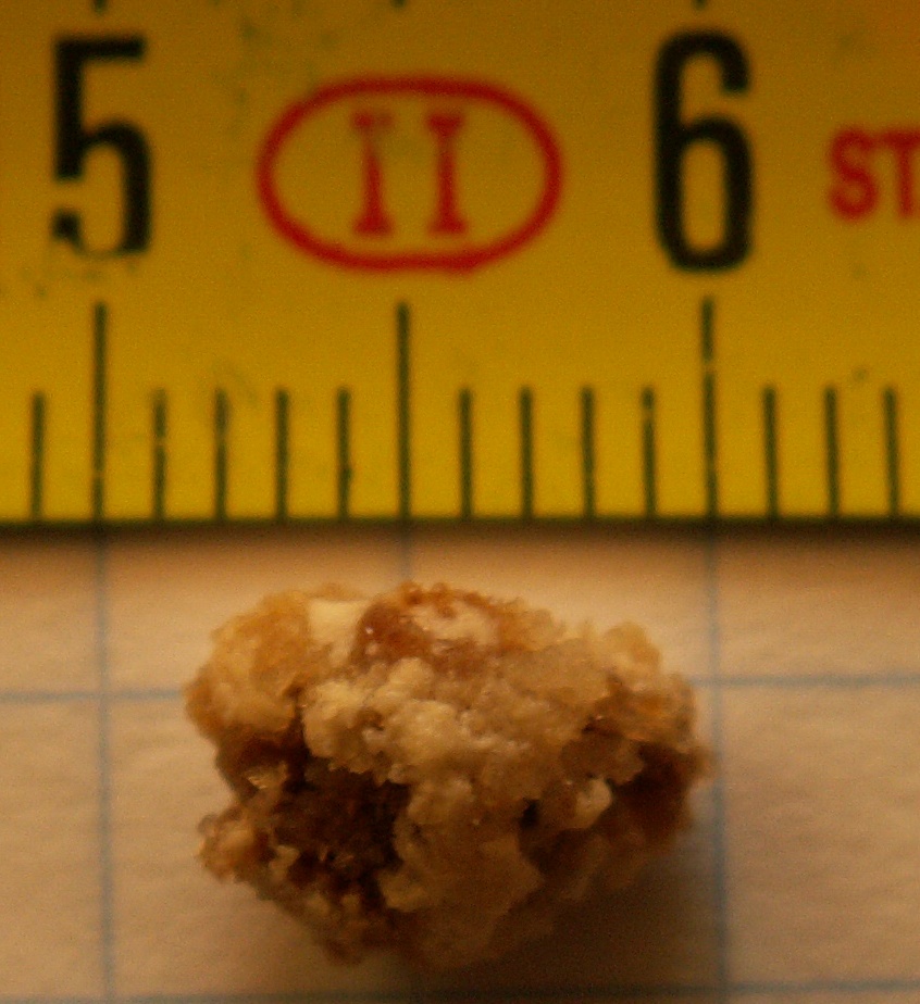 Kidney stone
