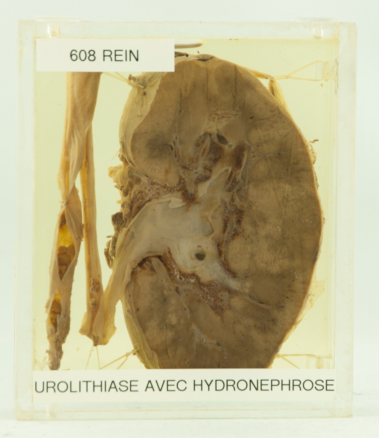 Diagnostic urolithiase avec hydron phrose histoire femme de