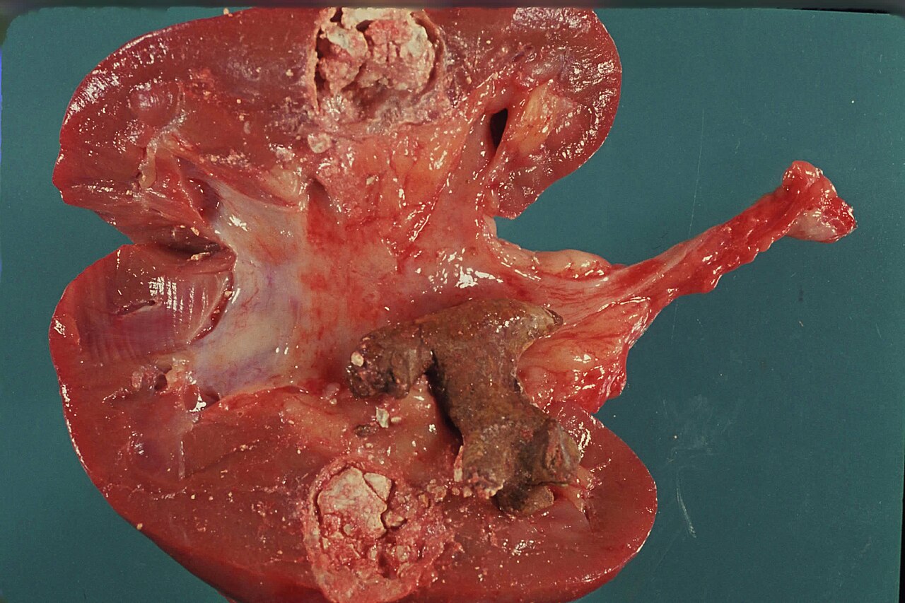 Calcium deposits in renal parenchyma note partial staghorn c