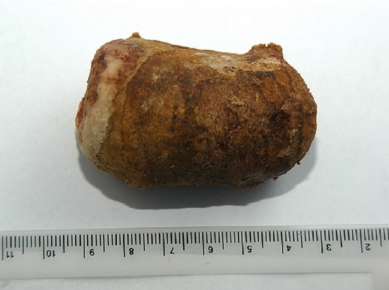 A giant ureter stone