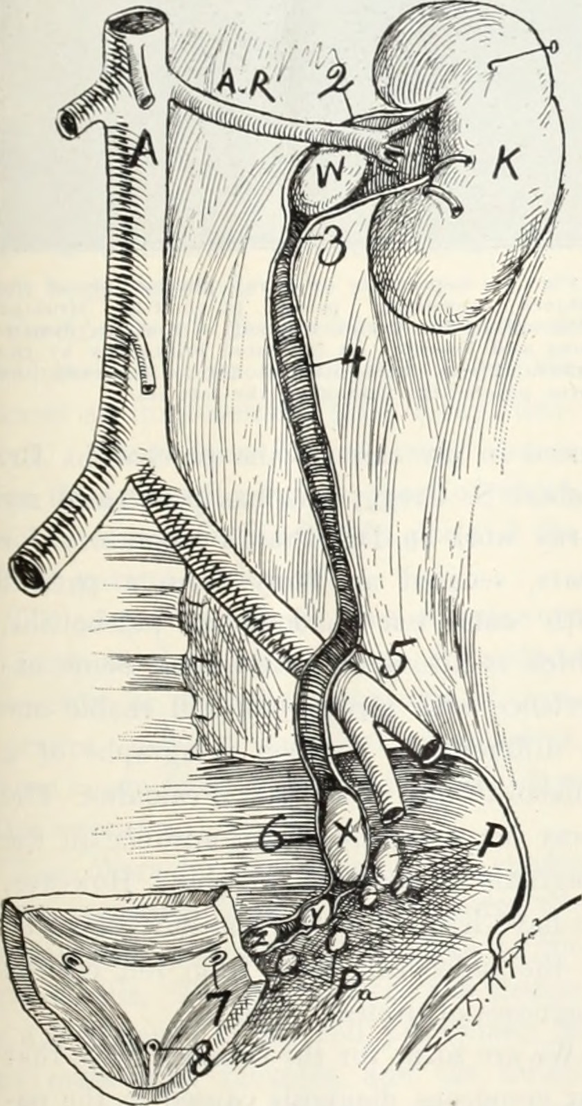 Fig 1 cut to illustrate the common location of ureteral calc