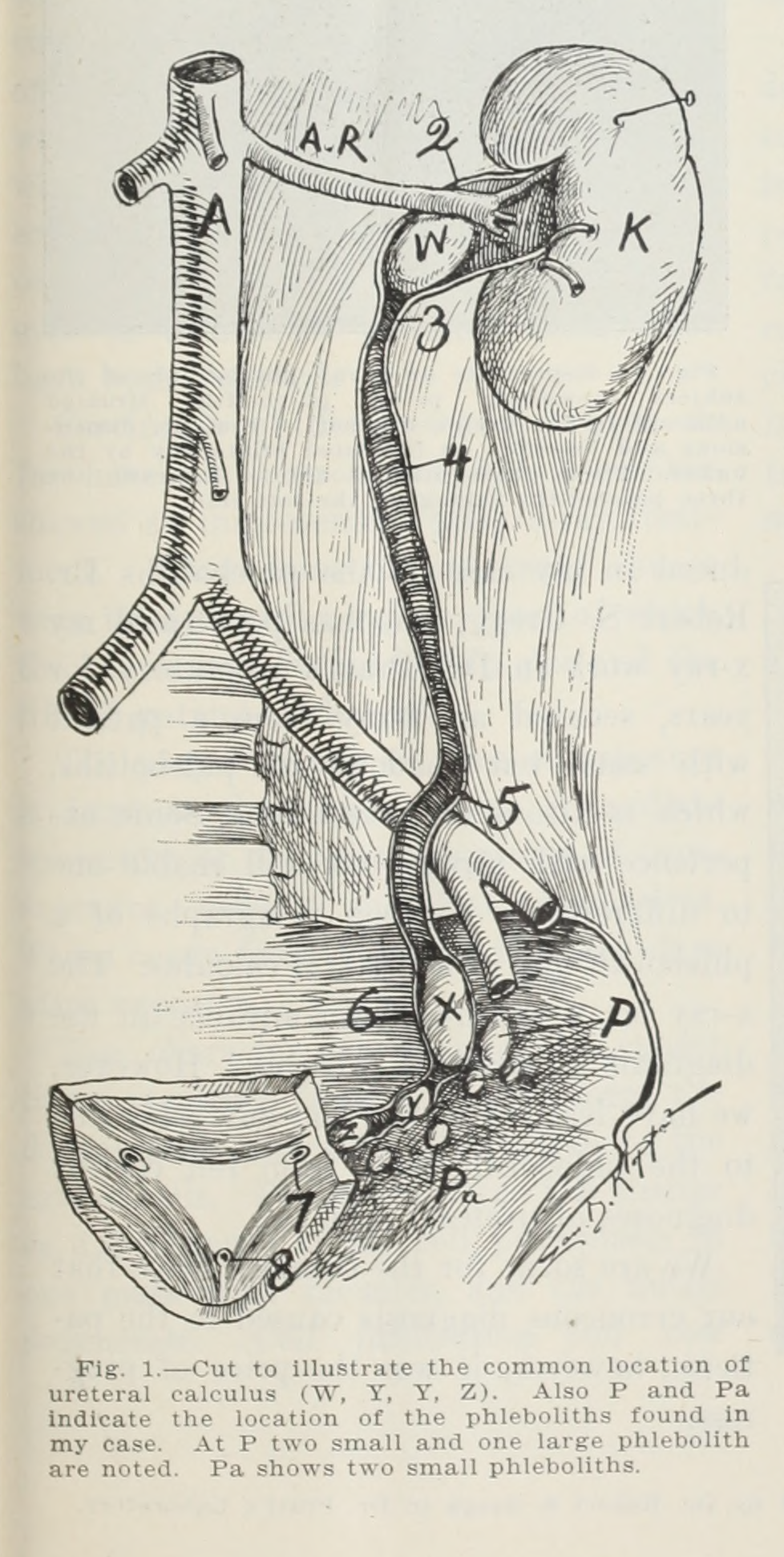 Cut to illustrate the common location of ureteral calculus e