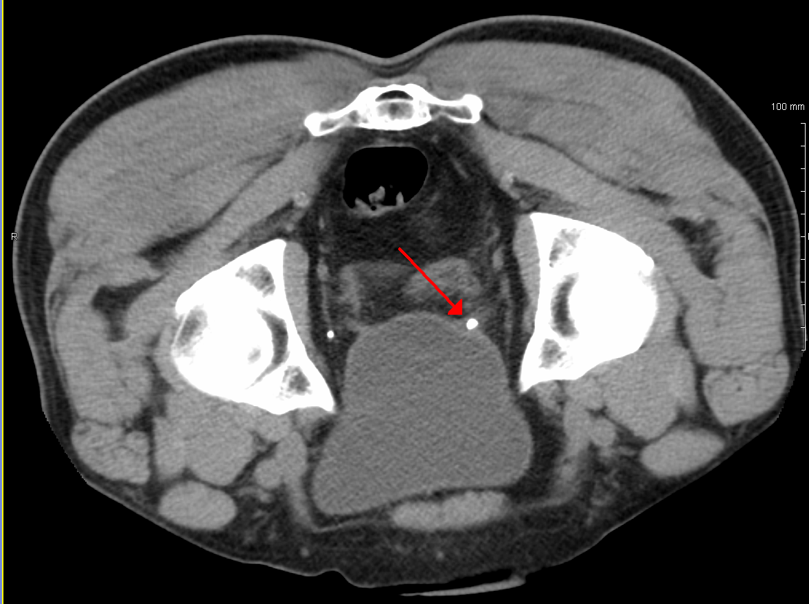 A stone at the ureteral vesicular junction