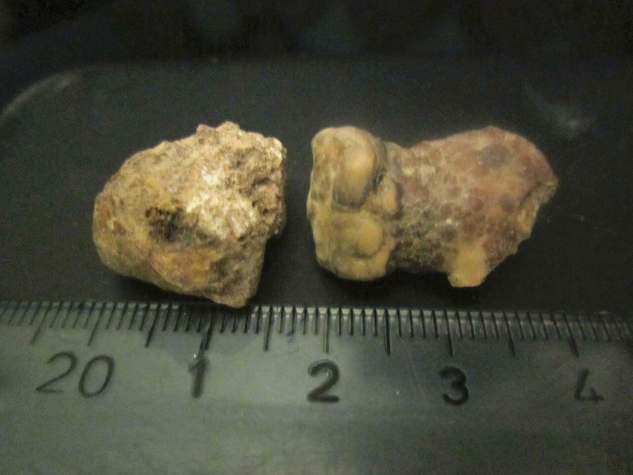 Kidney stones