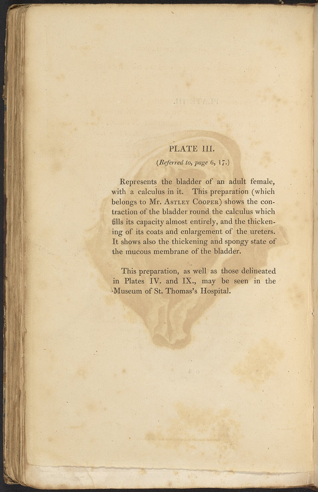 Alexander marcet 1770 1822 was a genevan physician who speci
